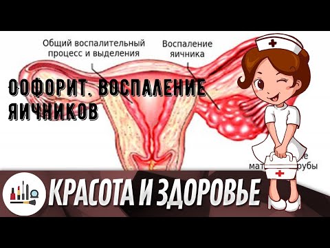 Оофорит. Воспаление яичников