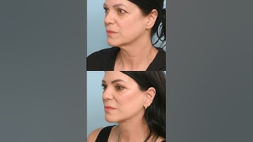 She Wanted Natural Results - Her Deep Plane Facelift Before and After at 57 Years Old #Facelift