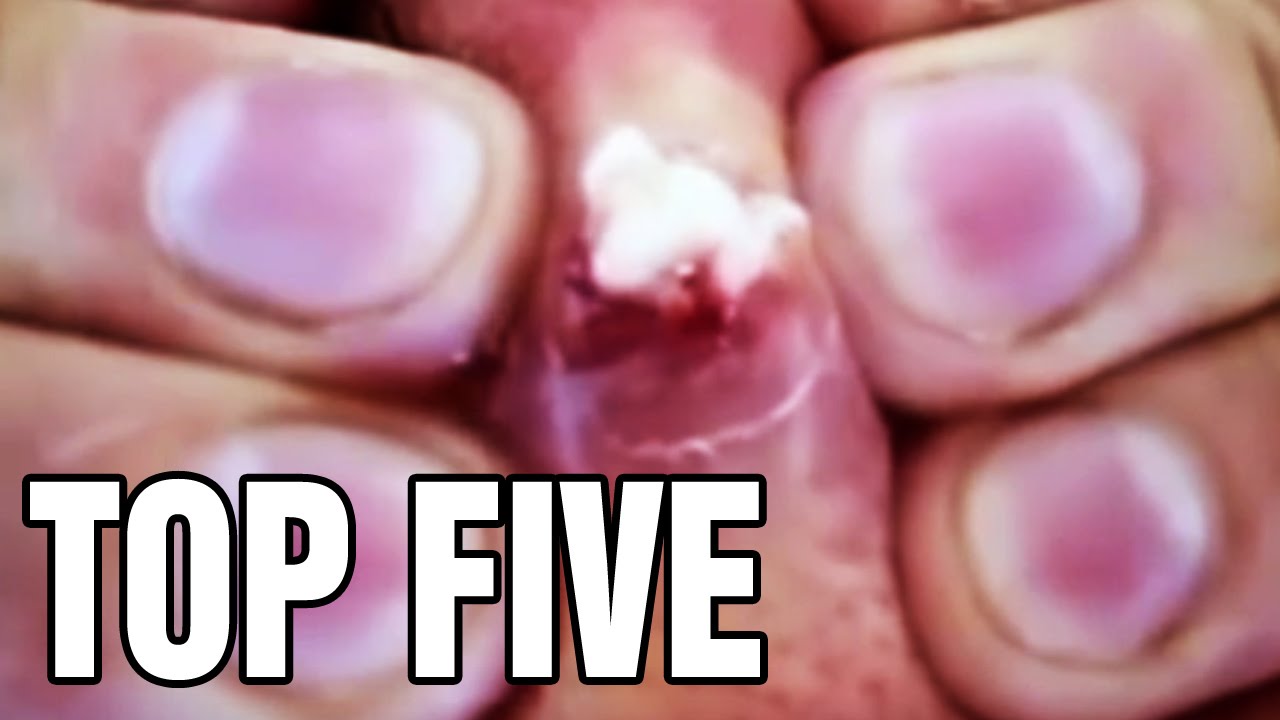 Pimple Popping; Top Five Zit Methods YouTube