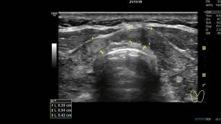 Клинический случай 17. (УЗИ Щитовидной Железы ) доктор А.В. Ушаков
