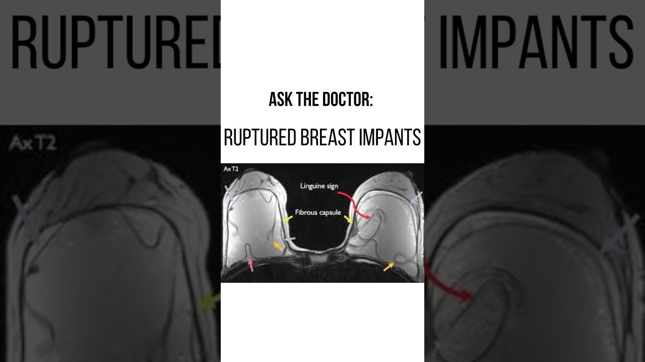 Ruptured/leaking breast implants