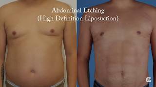 Abdominal Etching (or, High Definition Liposuction)