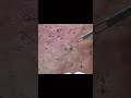 Blackheads for Days!!!