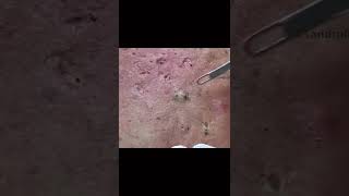 Blackheads for Days!!!