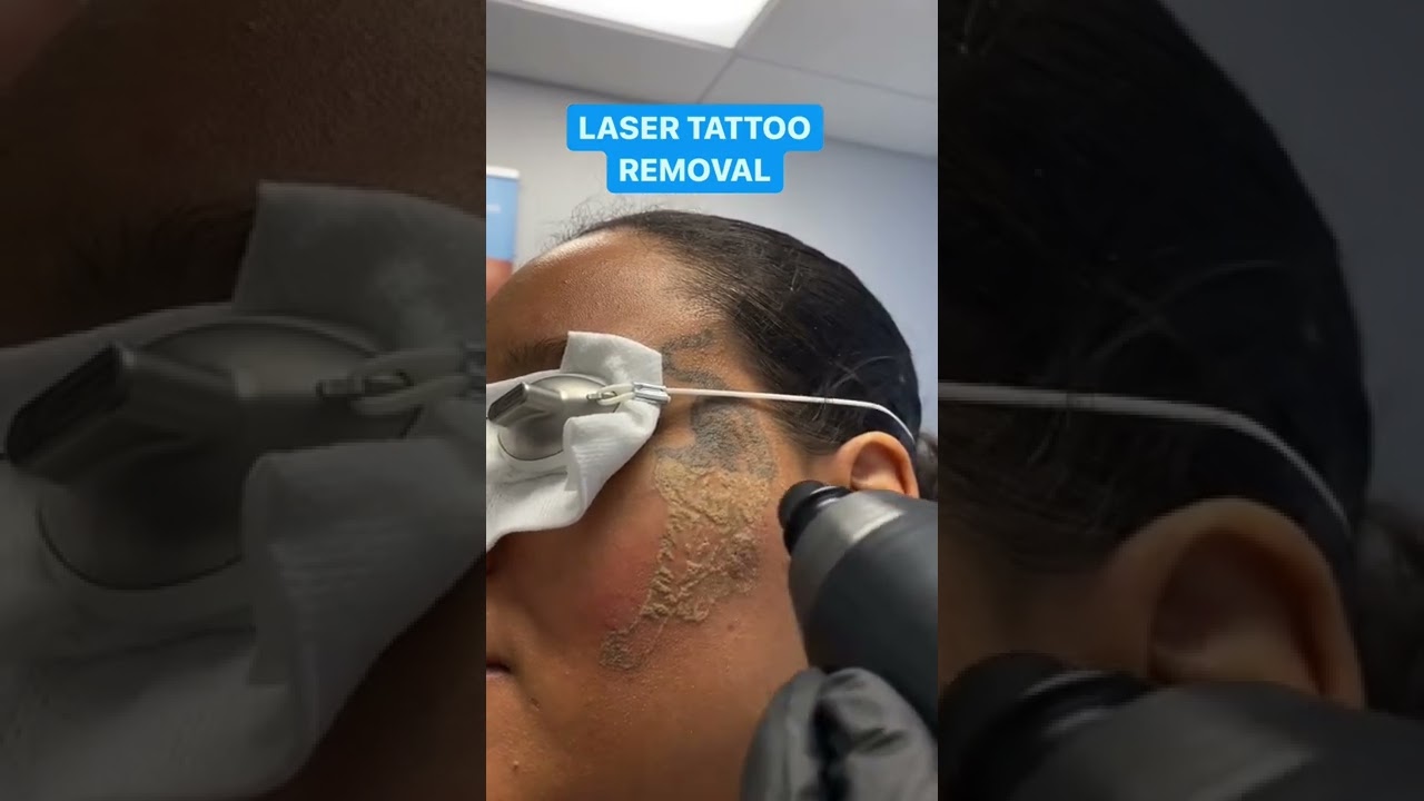 Laser Tattoo Removal