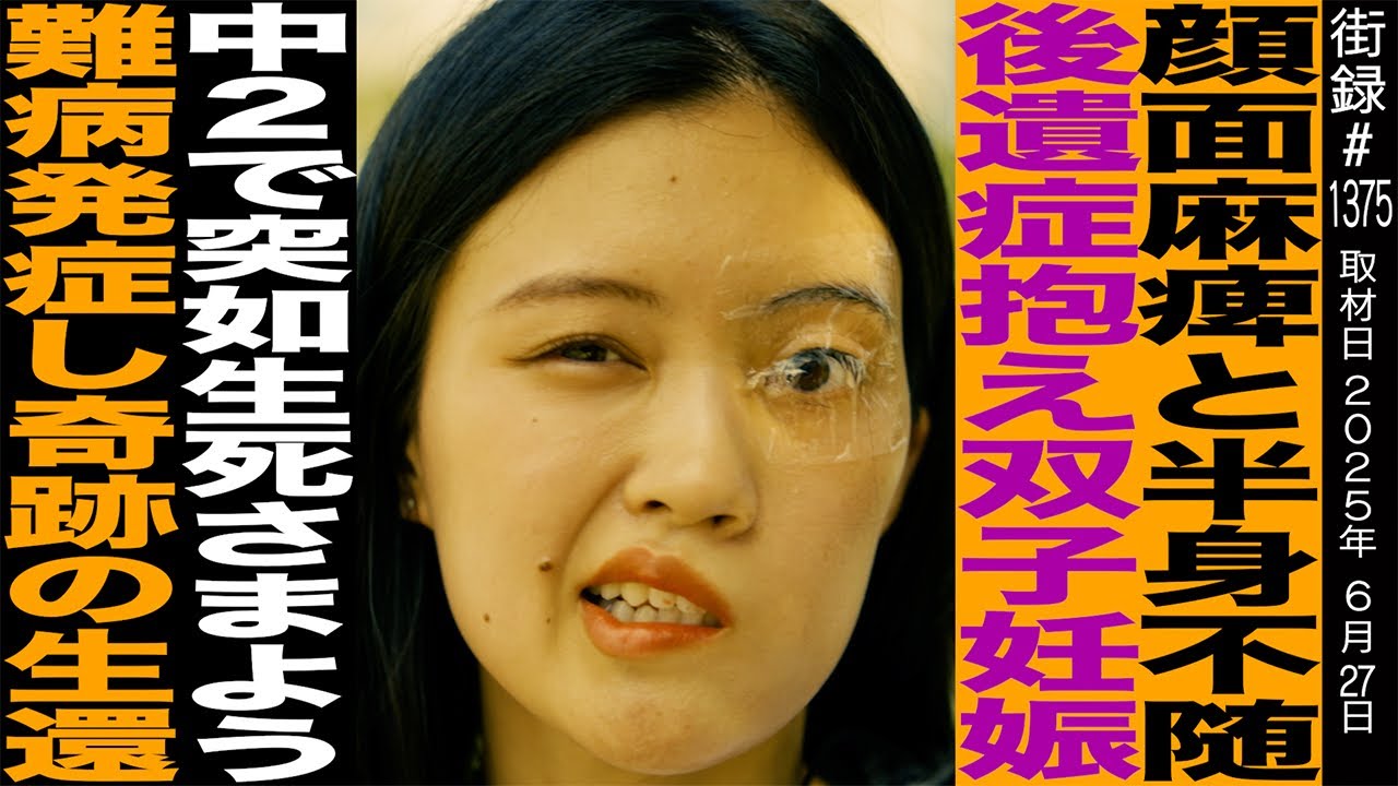 顔面麻痺と半身不随 後遺症抱え双子妊娠/中2で突如生死さまよう難病発症し奇跡の生還/SHIBUKI