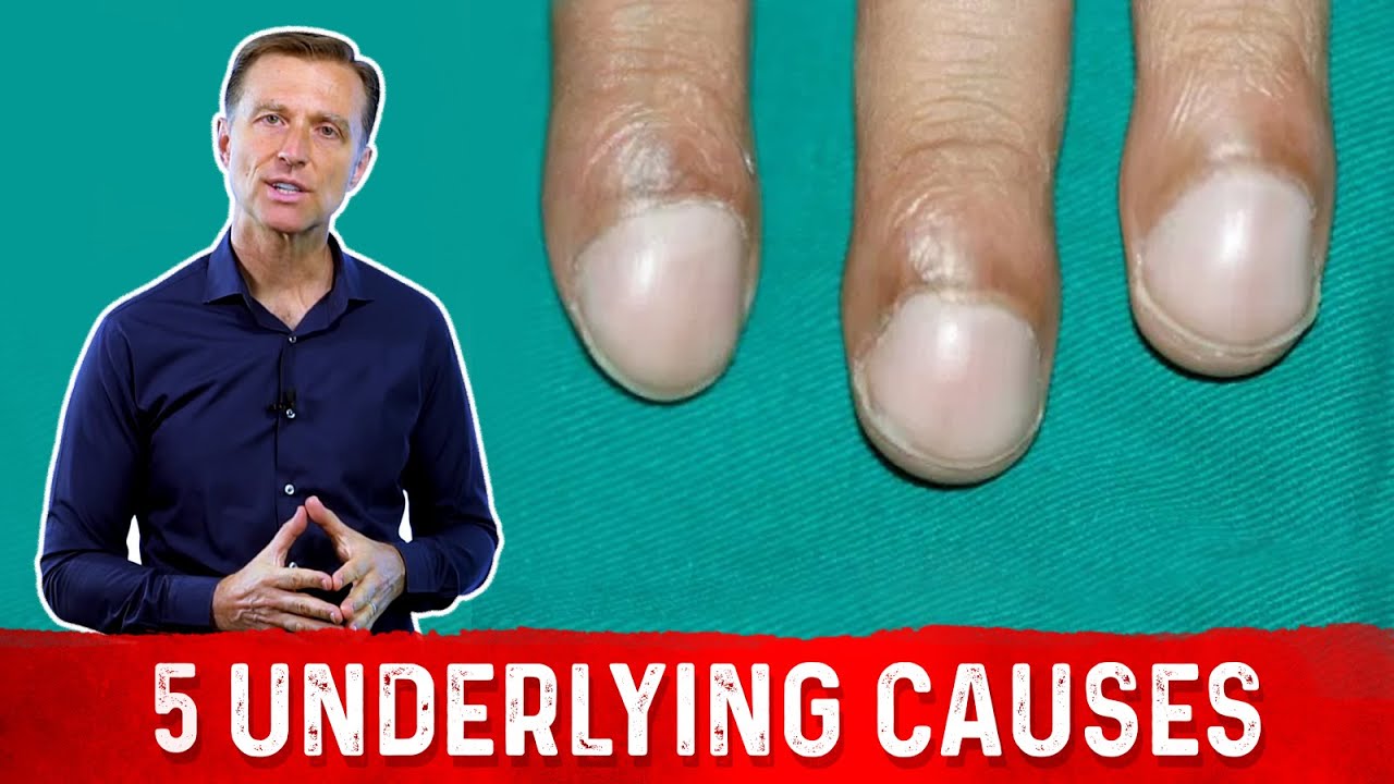 What is nail clubbing? Curved fingernails can signal lung cancer