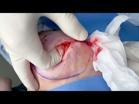 Video: Lipoma - Fjernelse, Alternativ Behandling, Symptomer