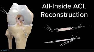 Anterior Cruciate Ligament Tears: ACL Reconstruction Using an All Inside Soft Tissue Graft Animation