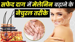 How to Increase Melanin Naturally in Hindi | मेलेनिन को कैसे बढ़ाये?| Vitiligo Treatment