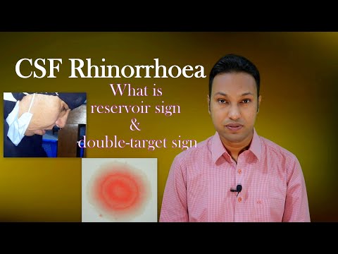 CSF Rhinorrhoea or Cerebrospinal Fluid Leak through Nose: Signs, Symptoms, Diagnosis & Treatment