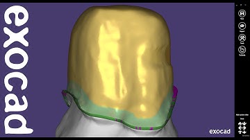 exocad Quick Guide: Crown Bottoms