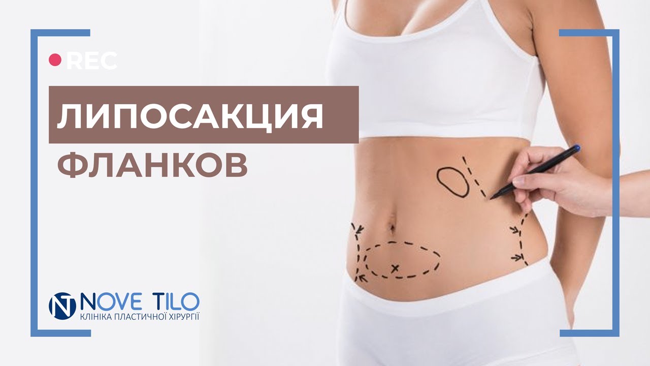 Липосакция фланков и миниабдоминопластика