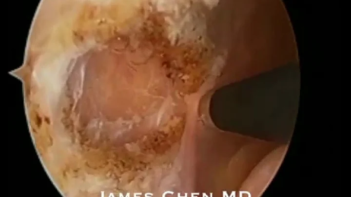Arthroscopic Lateral Release of the Knee