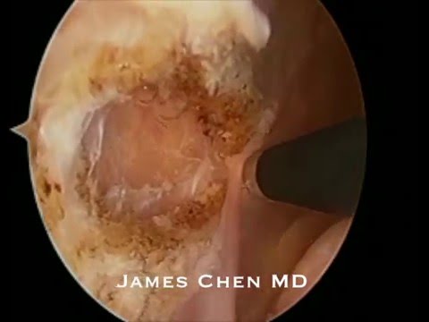 Videó: Mi az a laterális retinacularis felszabadulás?