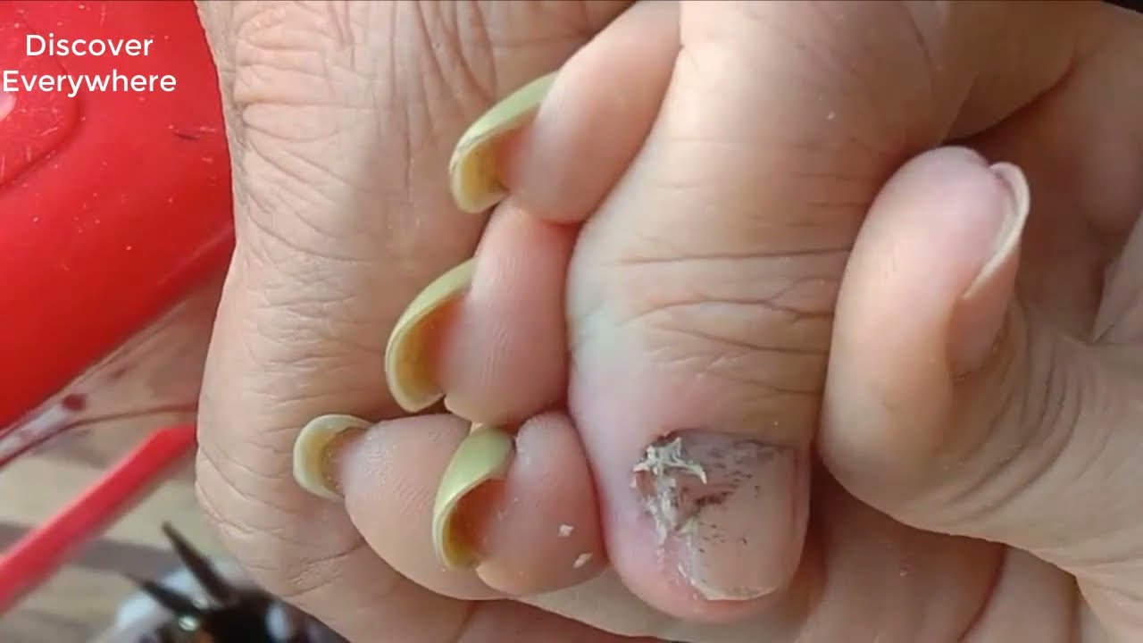 Deep Nail Removal and Cleaning YouTube