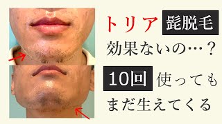 トリアは髭脱毛に効果ない？レベル５で10回脱毛した結果がヤバかった・・・