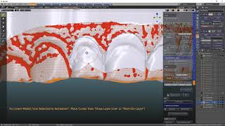 B4D Splint and Guide- Gingivectomy