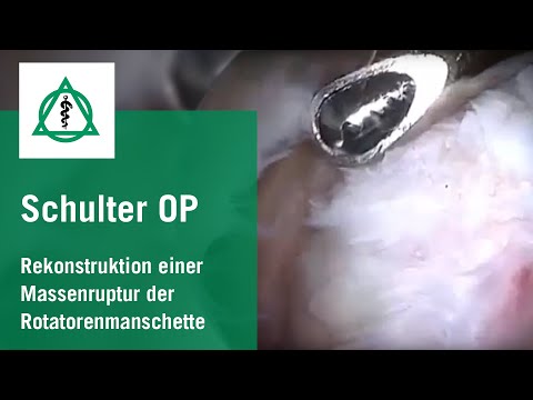Arthroskopische Rekonstruktion einer Massenruptur der Rotatorenmanschette (Schulter-Op)  | Asklepios