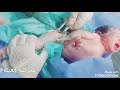 لحظه خروج الطفل من بطن الام وطريقه قطع الحبل السري والتشفيط ورضاعه الطفل بعد الولاده لحظه خروج الطفل من بطن الام وطريقه قطع الحبل السري والتشفيط ورضاعه الطفل بعد الولاده
