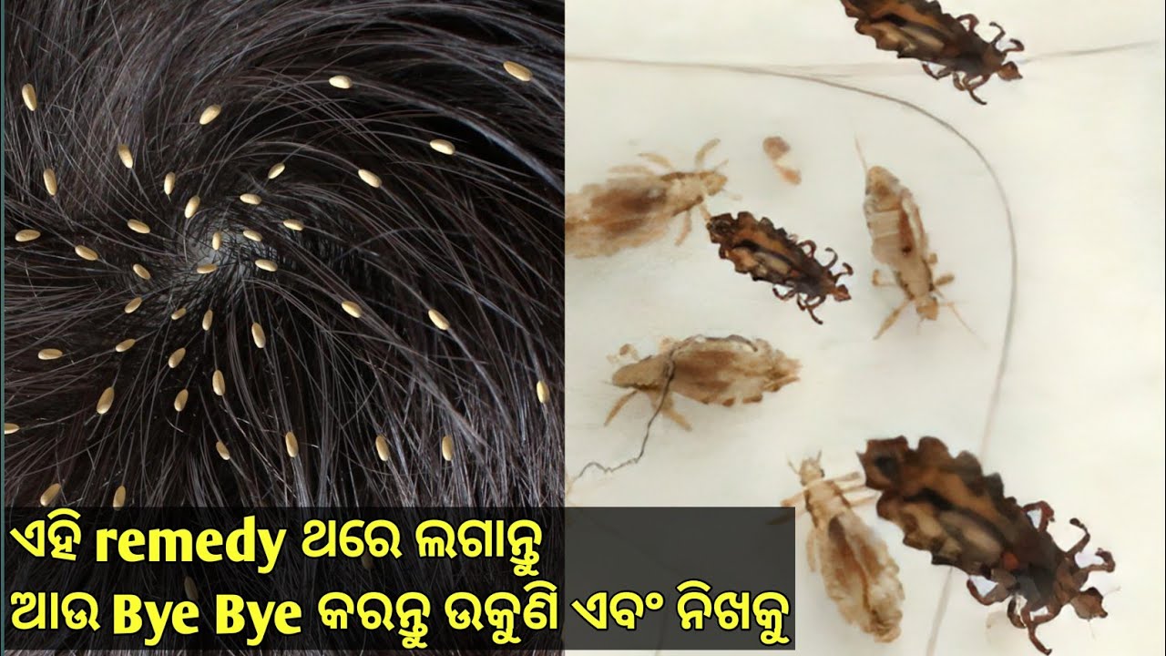 ଉକୁଣୀ ମୁଣ୍ଡରୁ ସଫା କରିବାର ସବୁଠୁ ସହଜ ଉପାୟ// Lice and nits removal home