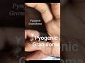 #pyogenicgranuloma #surgery #dermatology