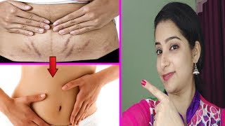 पुराने से पुराने Stretch Marks हटाएँ | Remove Stretch Marks Quickly