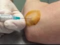 Tennis Elbow Injection Lateral Epicondylitis Treated with Cortisone Injection