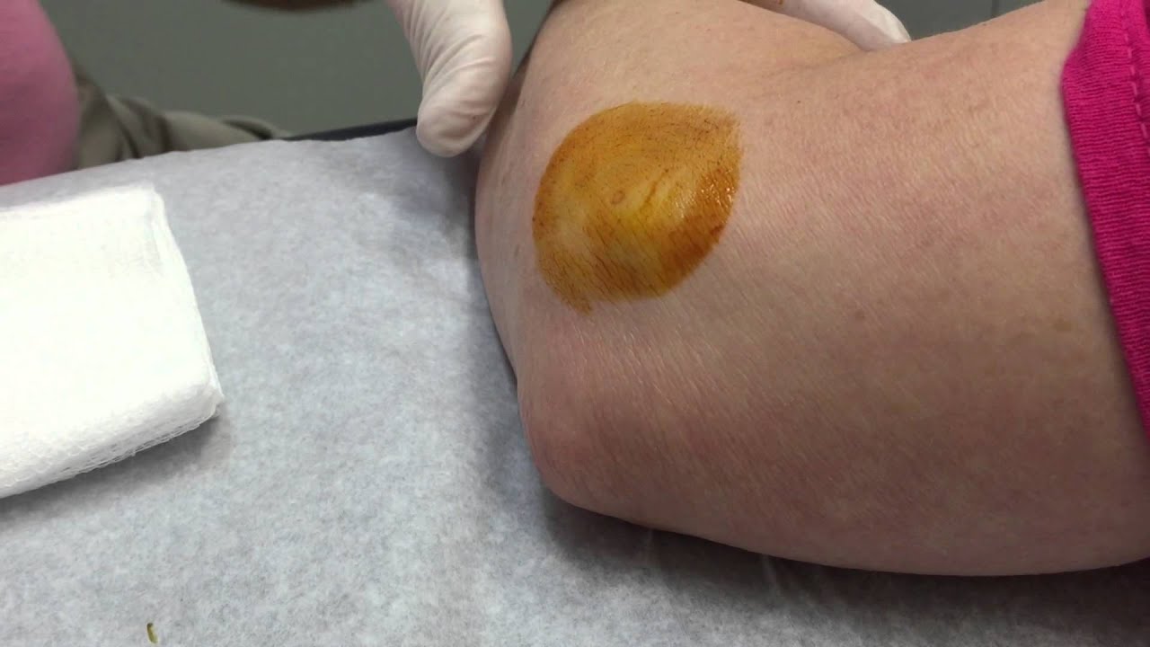 Tennis Elbow Injection Lateral Epicondylitis Treated with Cortisone