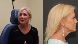 Celebrity Facelift Healing Post-Op Day 14! Profile