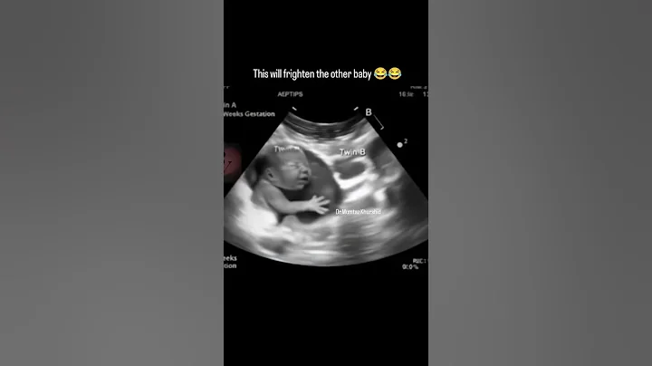Funny AI Twin Pregnancy on Ultrasound