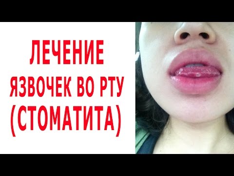 ★Как избавиться от ЯЗВЫ ВО РТУ. СТОМАТИТ излечим народными методами.