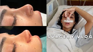 MY 3RD NOSE JOB | RHINOPLASTY RECOVERY &amp; REVEAL