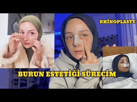 BURUN AMELİYATI SÜRECİM | VLOG