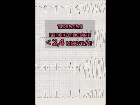 #гипокалиемия  #ecg #экг #ekg