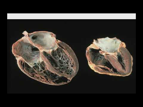 Heart Failure (HfpEF & HFrEF) diagnosis and aetiology -Dr Sudhir Kushwaha/ Mayo clinic & BSC 2020