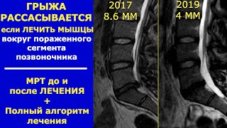 Может Ли Грыжа Исчезнуть? Резорбция Грыжи Диска Позвоночника. 14+