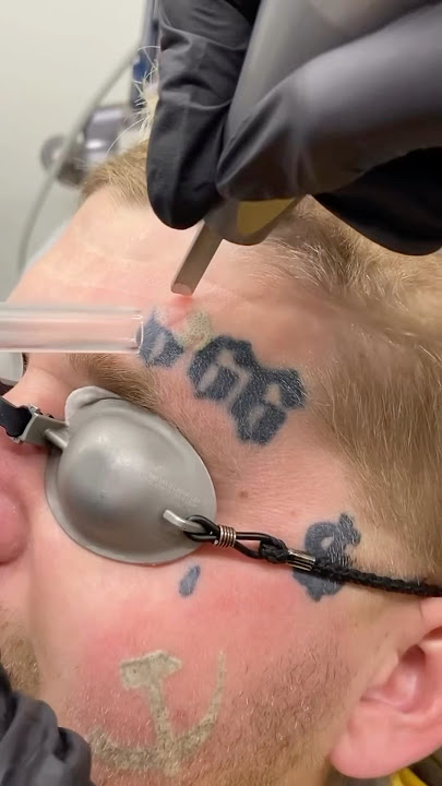 Satu detik $200 Rahasia Teknik Menghapus Tattoo