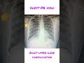 Chest PA view With right upper lobe consolidation #motivation #medical #radiology #facts #shorts