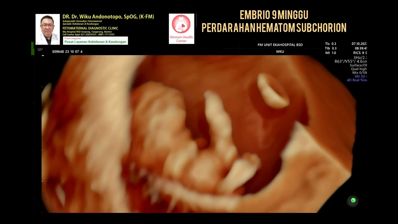 Kehamilan 9 weeks abortus imminens
