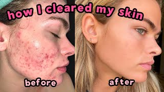 My Accutane Experience & How I Cleared My Severe Acne + Q&A (with lots of pictures!)