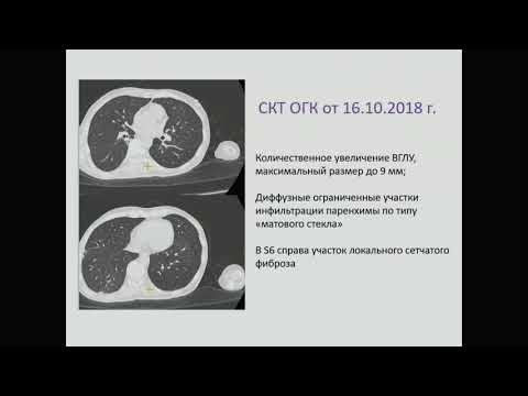 Клиническая демонстрация случая ВИЧ-инфекции с развитием синдрома восстановления иммунной системы.
