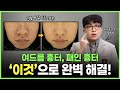 여드름흉터, 패인 흉터에 효과 직빵인 울트라콜 총정리!