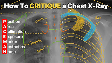 How To Critique a Chest X-Ray! CXR Interpretation