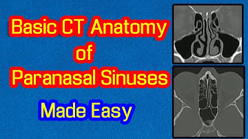 Basic CT Anatomy of Paranasal Sinuses, Made Easy