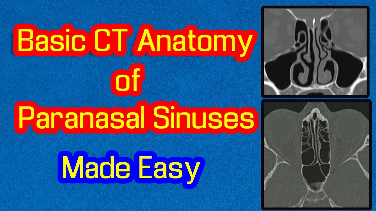 Basic Ct Anatomy Of Paranasal Sinuses Made Easy Youtube