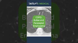 🔍 CT Scan Insights: Bullae & Paraseptal Emphysema! #EmphysemaInsights #RadiologyRevealed #usmle