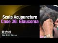 Tais scalp acupuncture  case 36 glaucoma