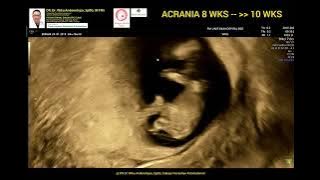 Acrania early diagnosed 8weeks -- 10 weeks