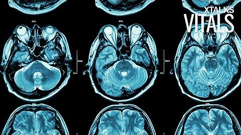 Diagnosing Concussions Based on High-Resolution Brain Imaging and Machine Learning